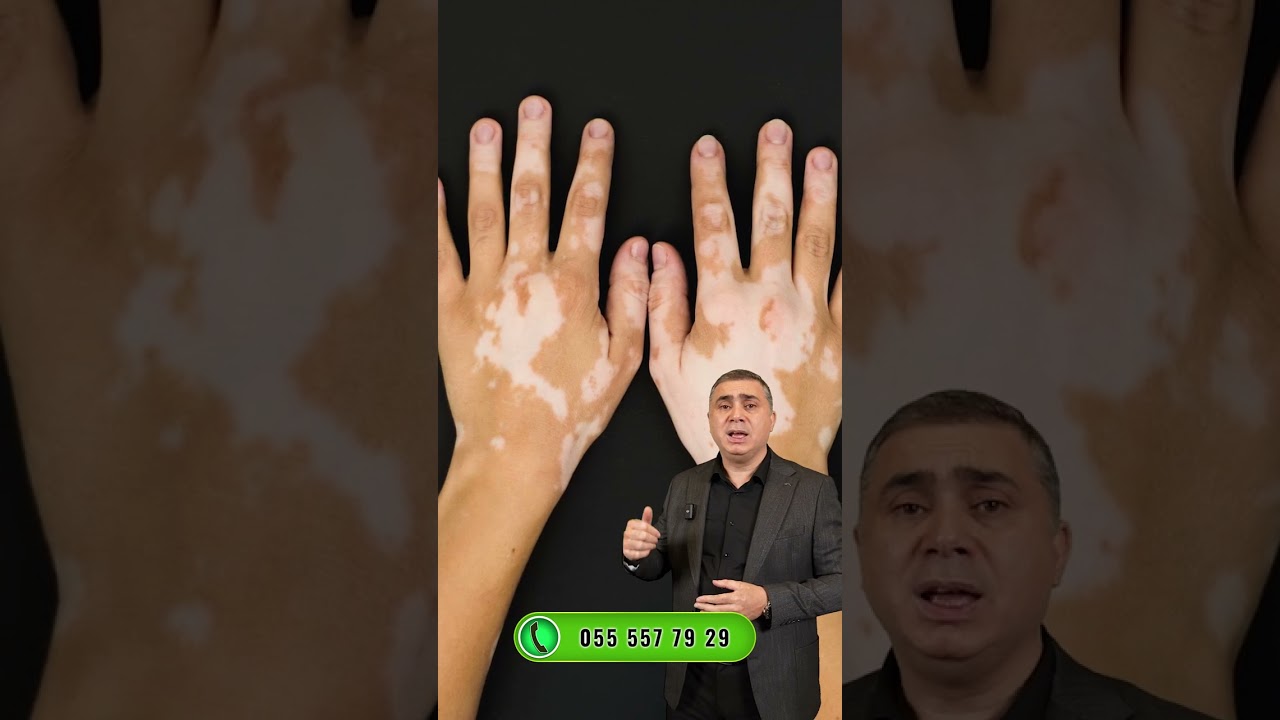 Vitiliqo xəstəliyi nədir?