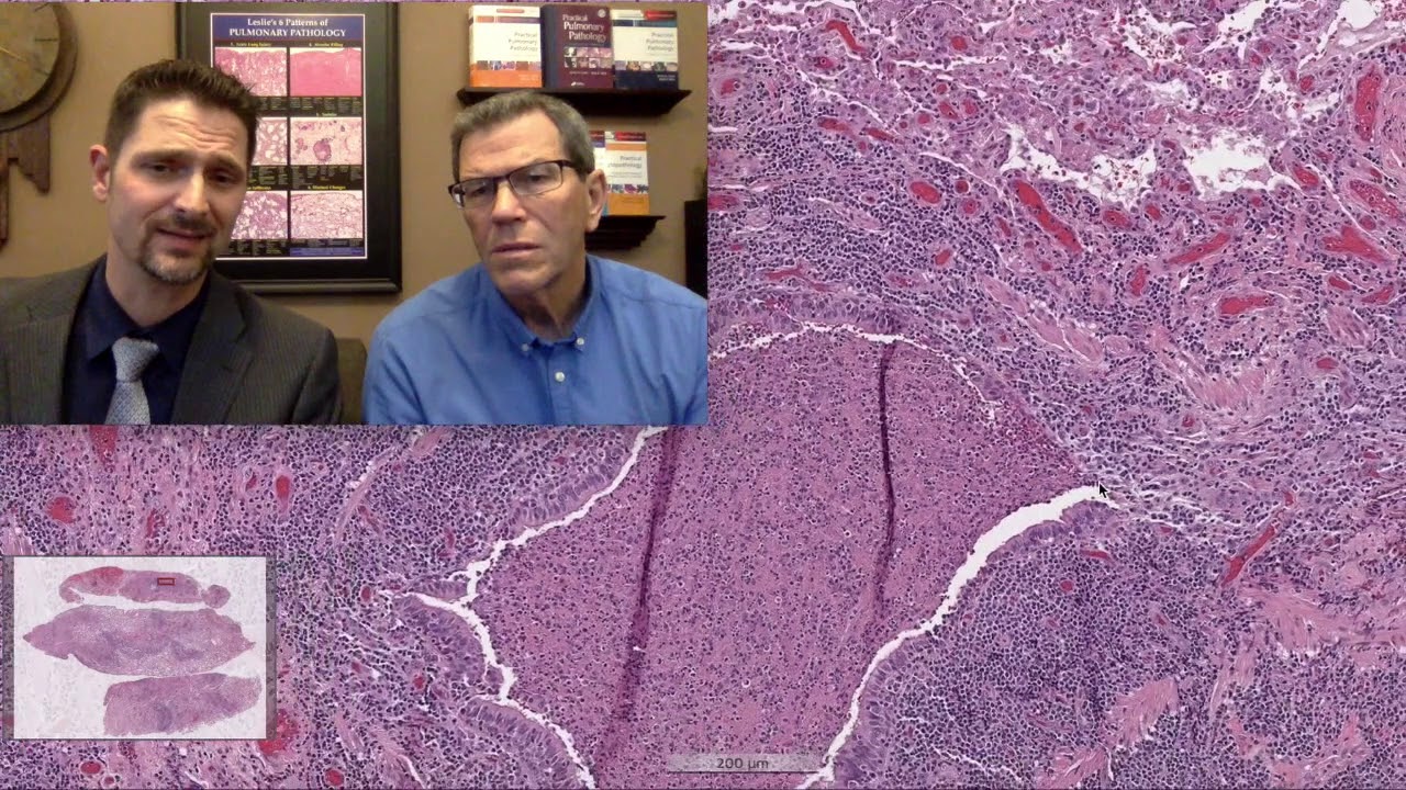 Pattern 5 – Nodules, MALT Lymphoma (Top 25 Pearls Series, Topic 4, Pearl 3)