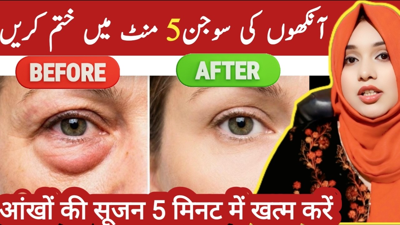 This Simple Trick Treat Puffy Eyes Naturally