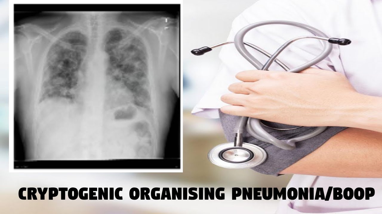Cryptogenic organising Pneumonia | BOOP