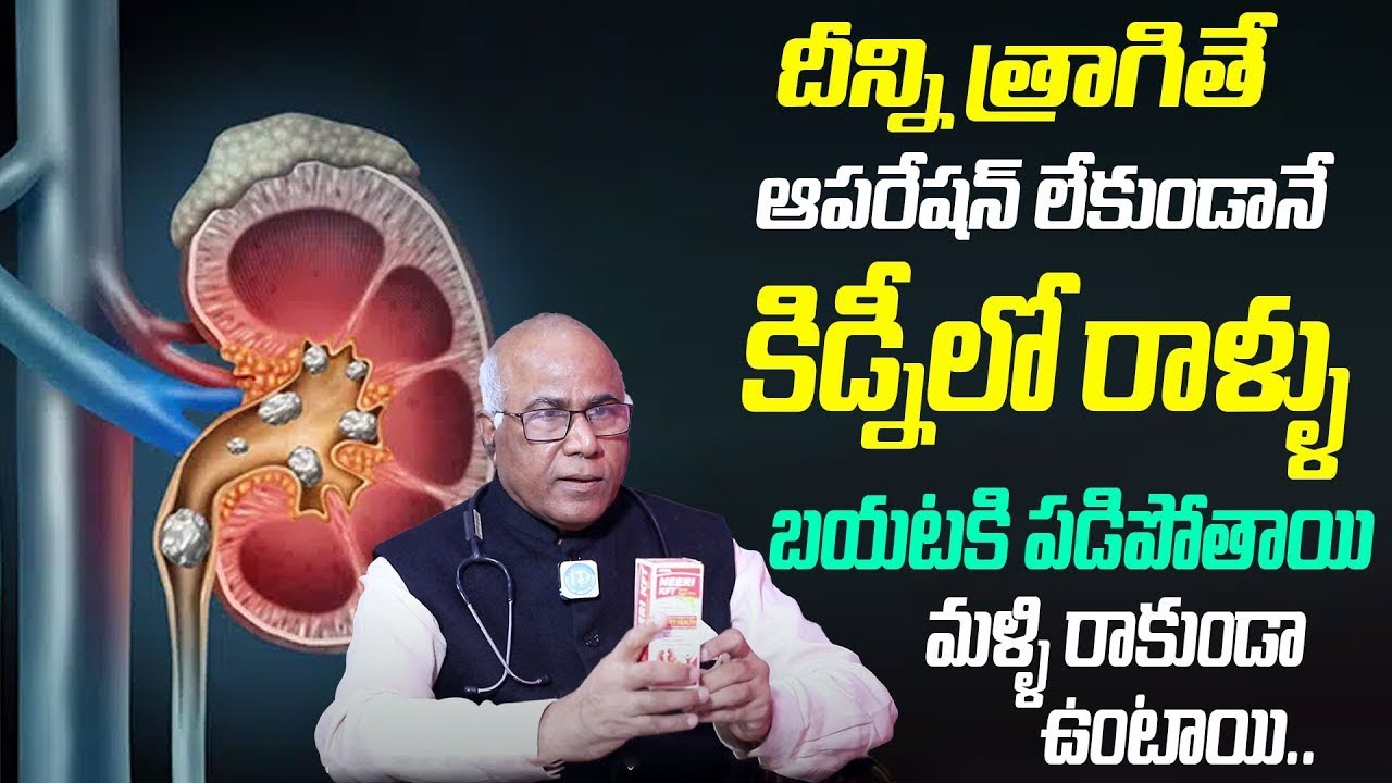 Dr Cl Venkat Rao - How to Reduce Kidney Stones || Removes Kidney Stones || iDream Prime
