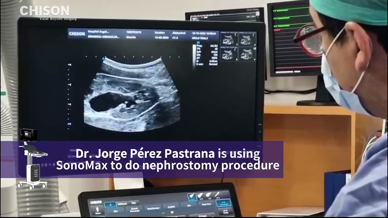 Ultrasound-guided nephrostomy performed by Dr. Jorge Pérez Pastrana using the CHISON ultrasound syst