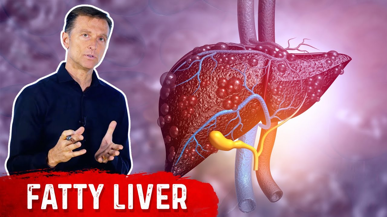 Why Does a Fatty Liver Have No Symptoms? &ndash; NAFLD (Non Alcoholic Fatty Liver Disease) by Dr.Berg