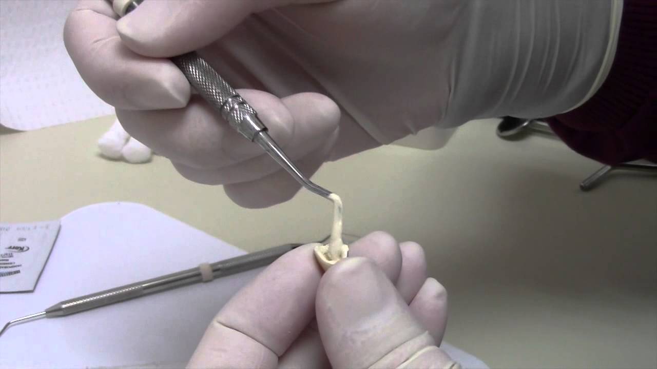 How to Cement a Temporary Crown