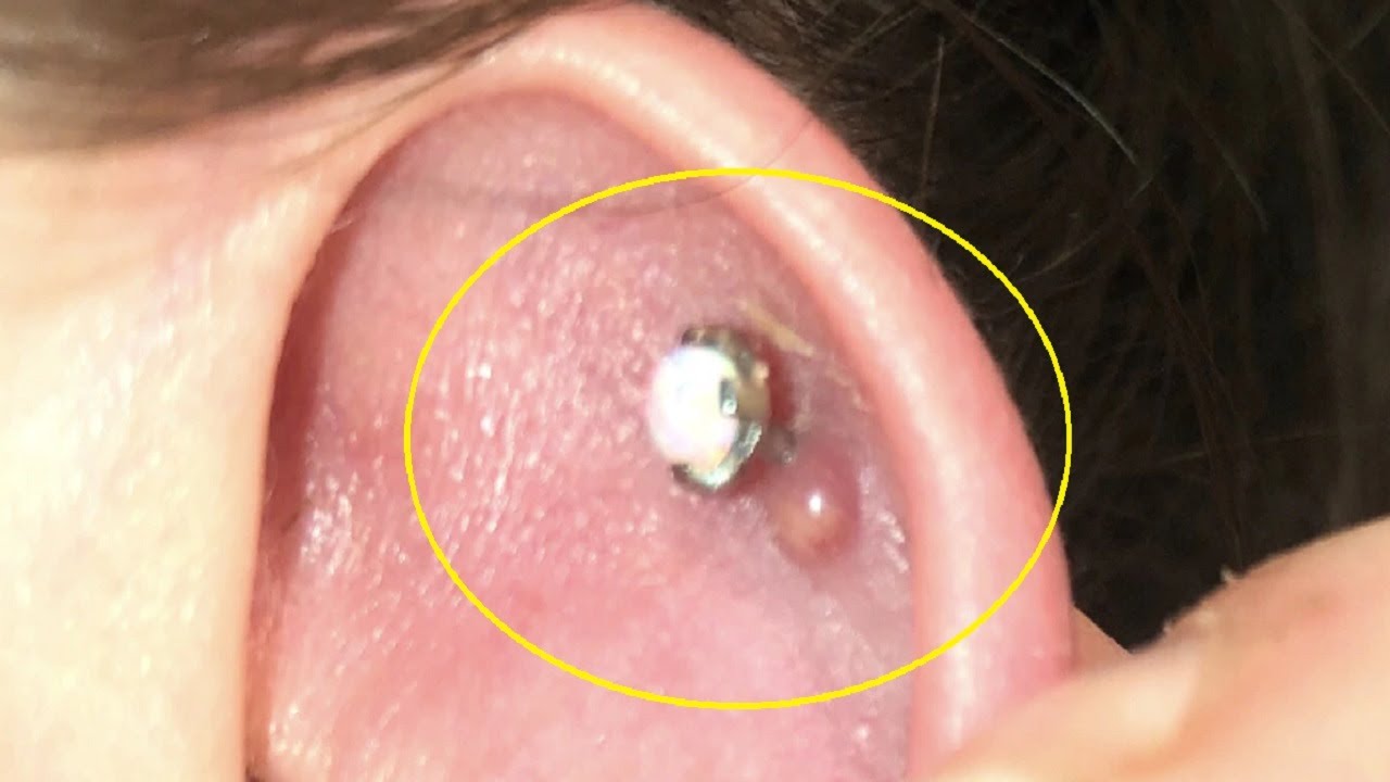 how to get rid of ear piercing bump fast