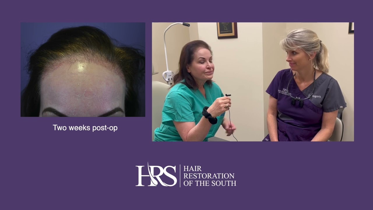 Telogen Effluvian - Shock Hair Loss After Hair Transplant