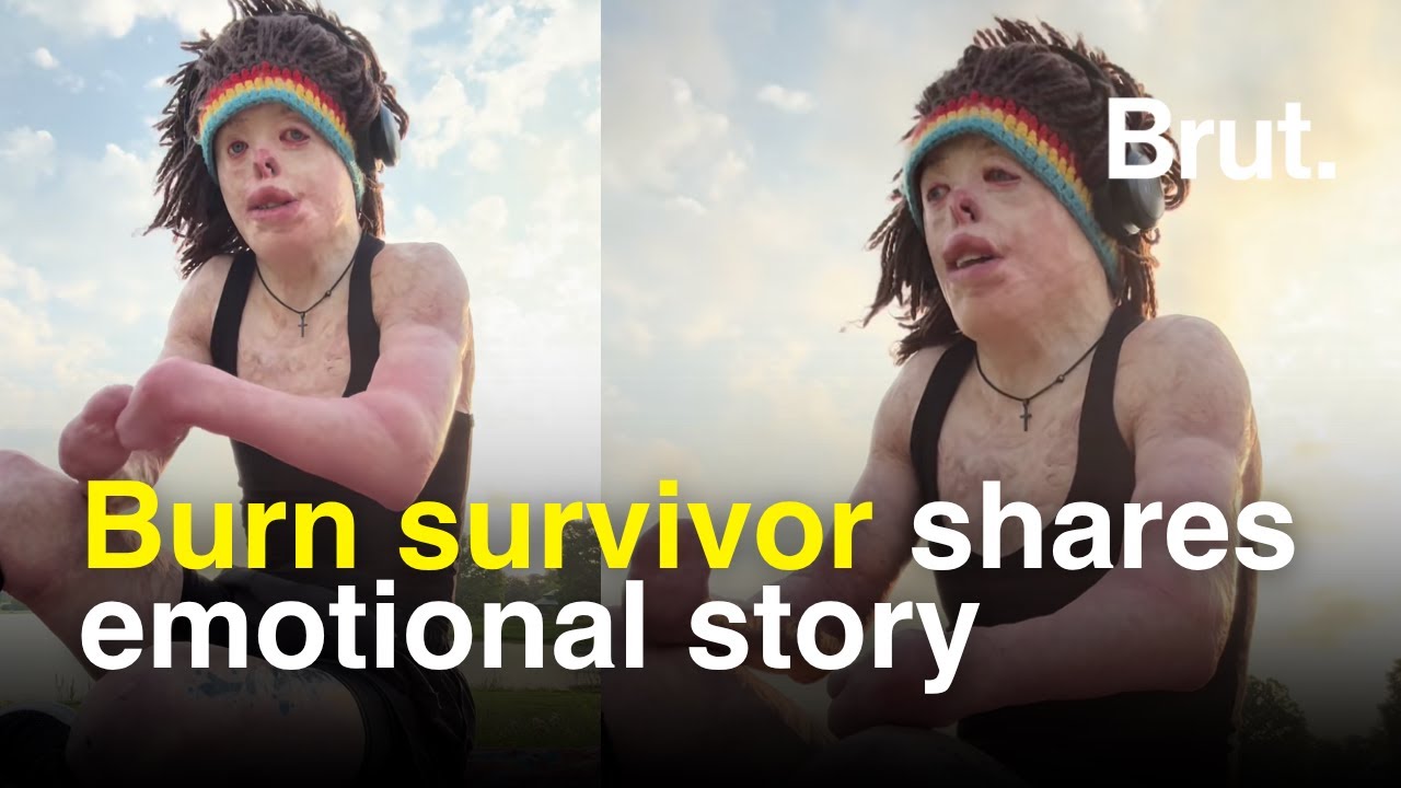 Burn survivor, Johnny Quinn, shares emotional story