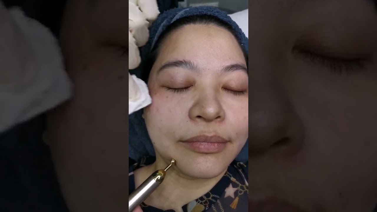 Intredermal injection for pigmentation with Dermalsign E+