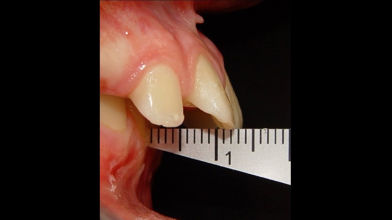 Modern concept to treat severe class II in children using 2x4 Appliance
