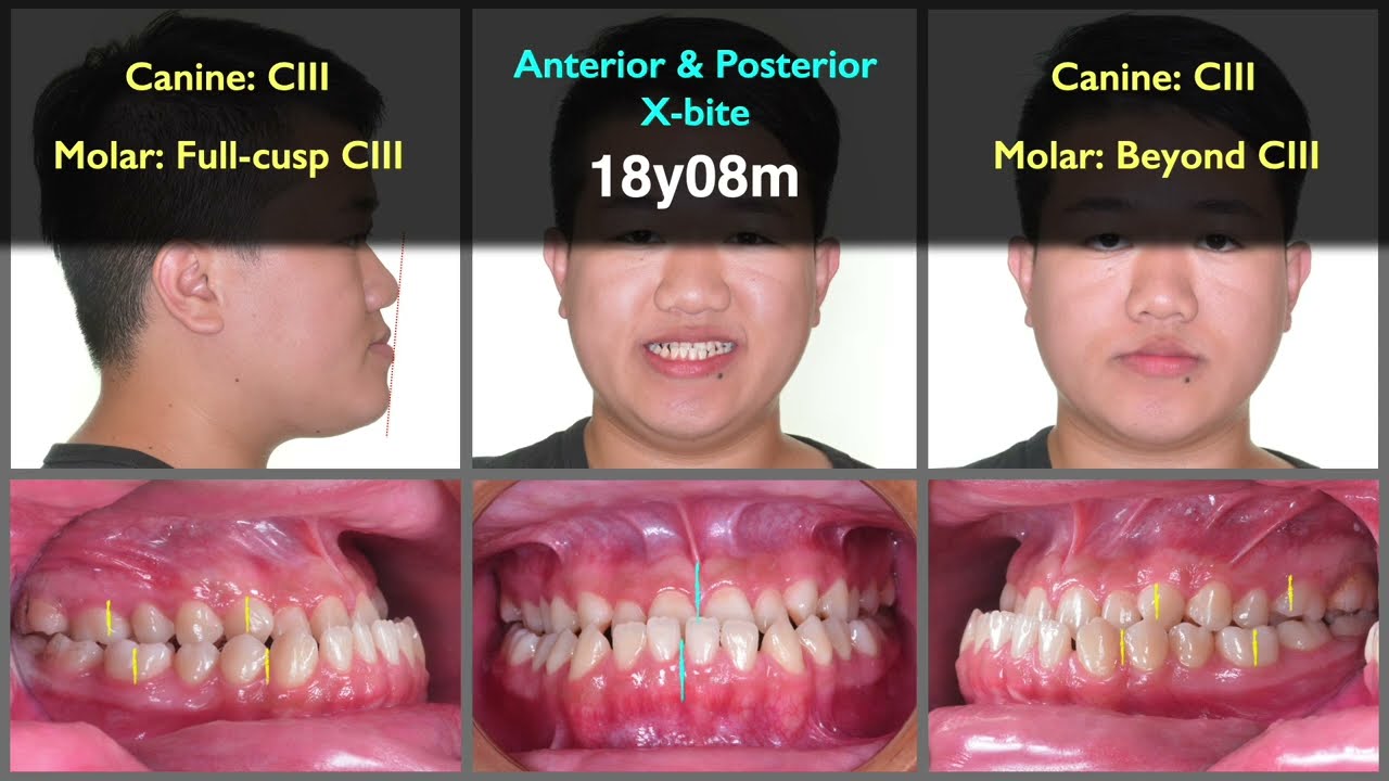 Skeletal Class III with posterior crossbite｜【Chris Chang Ortho】CC807
