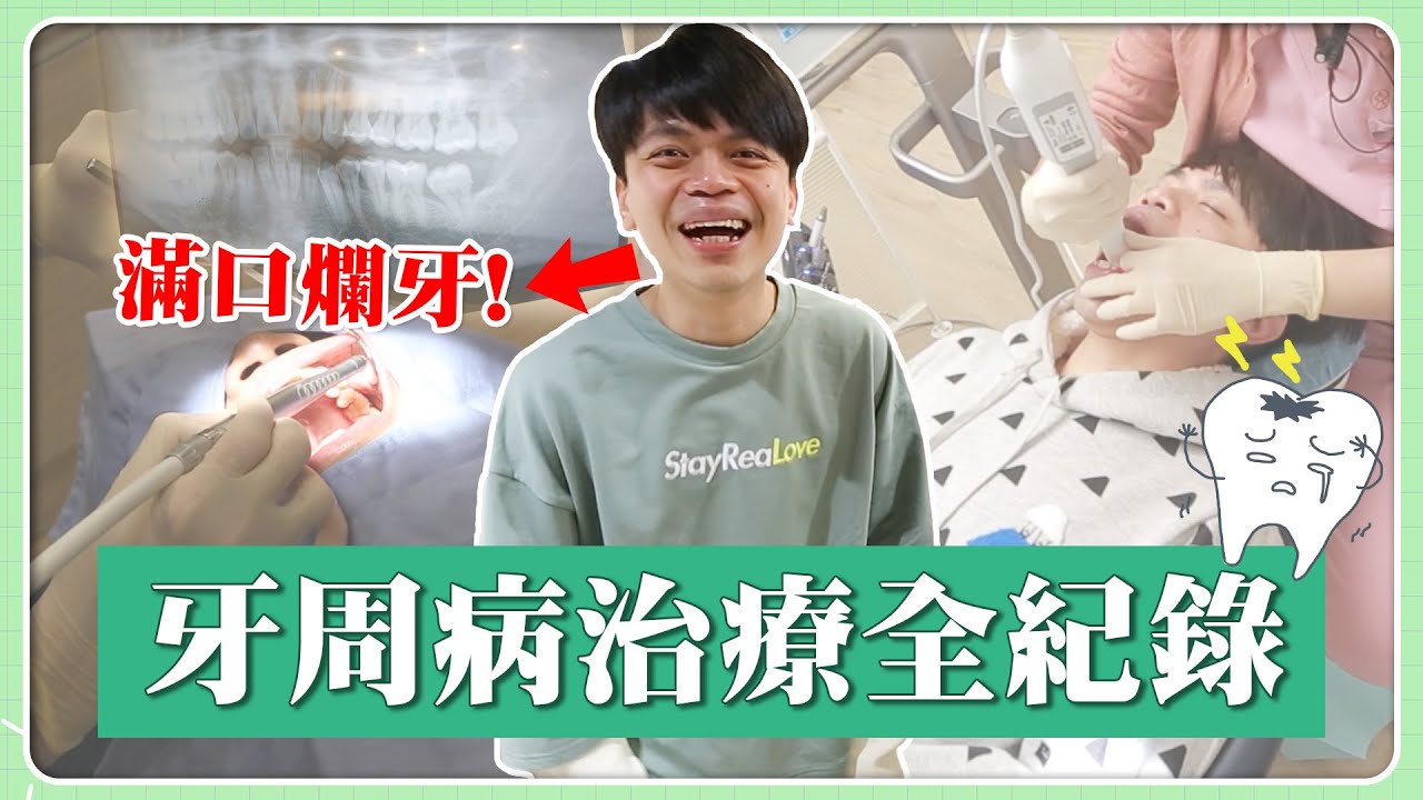 滿口爛牙！蔡阿嘎牙周病治療全紀錄！