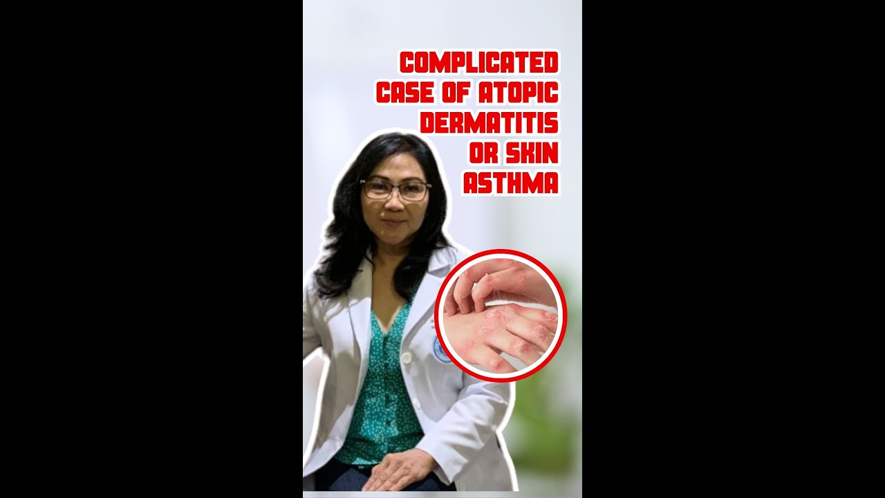 Complicated Case of Atopic Dermatitis or Skin Asthma