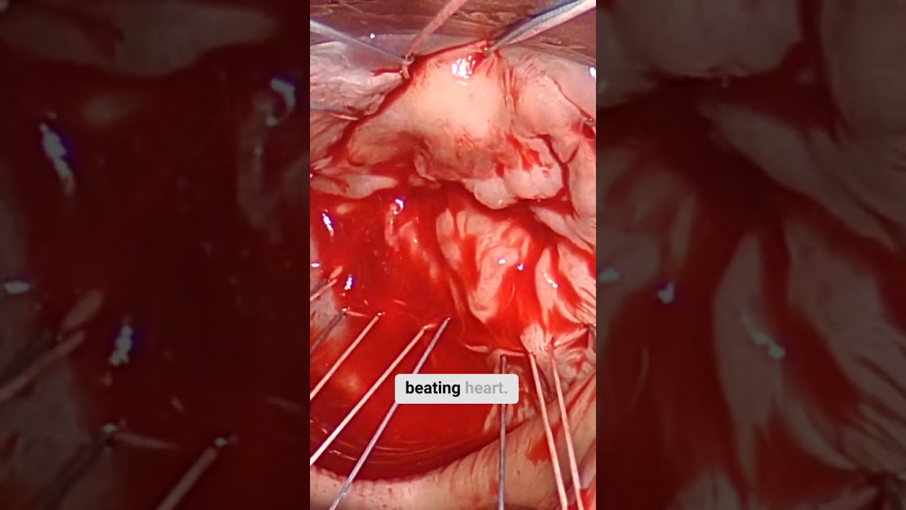 On-Pump Beating Heart Mitral Valve Repair Through Right Anterior Mini Thoracotomy #cardiac #CABG