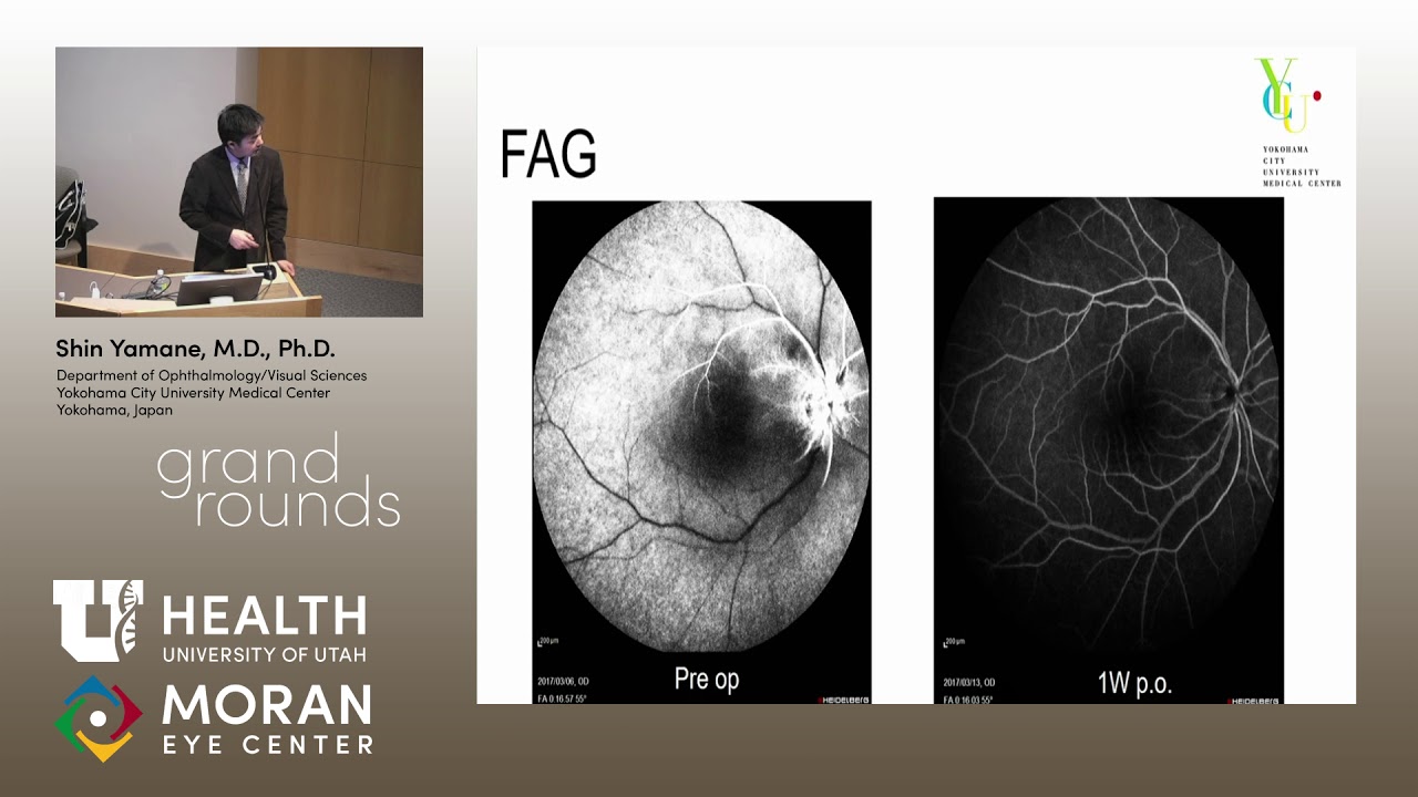 Endovascular Surgery for CRAO