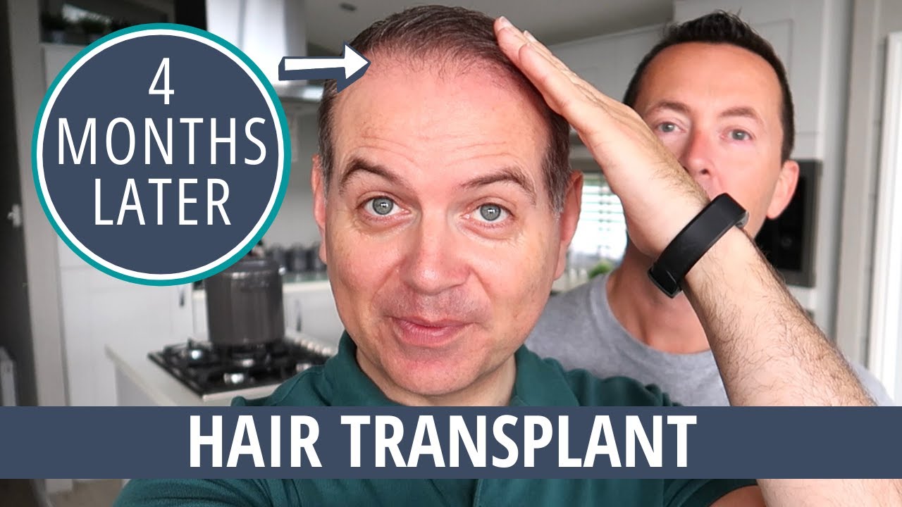 HAIR TRANSPLANT UPDATE | 4 MONTHS LATER