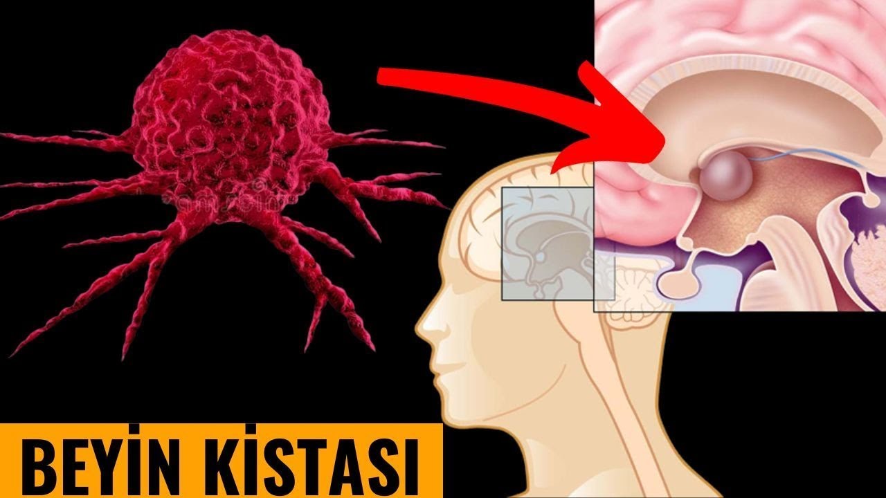 Beyin Şişləri, Kista - Əməliyyat olunmağa ehtiyac yoxdur?