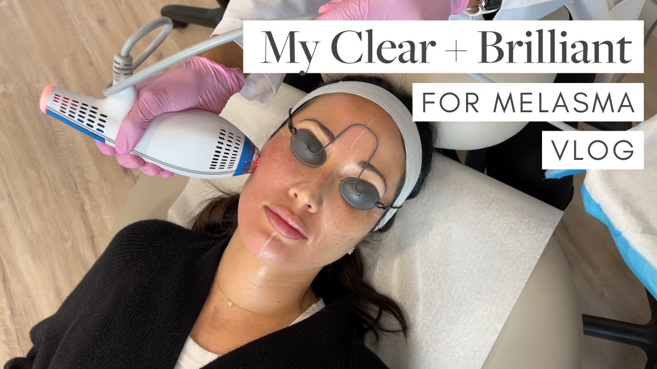 My Clear + Brilliant Laser Treatment for Melasma with Dr. Nina Desai! | Susan Yara