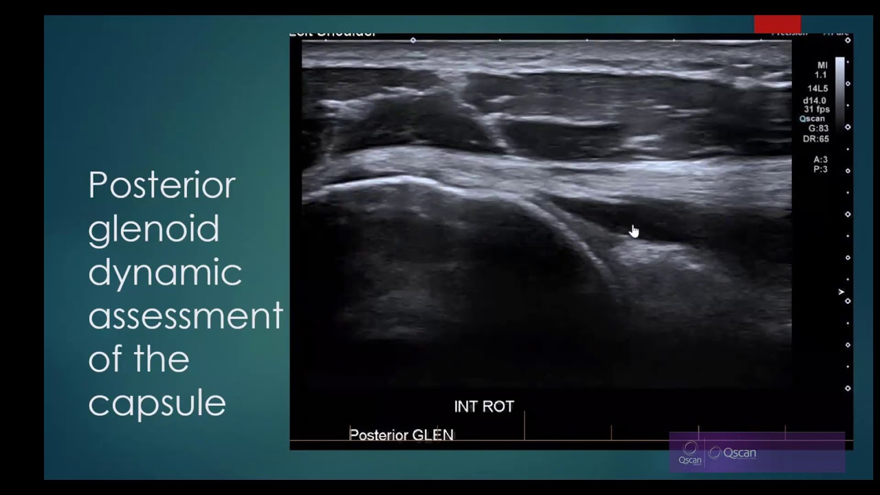 Ultrasound Inf Glenohumeral Lig in Adhesive Capsulitis of the Shoulder