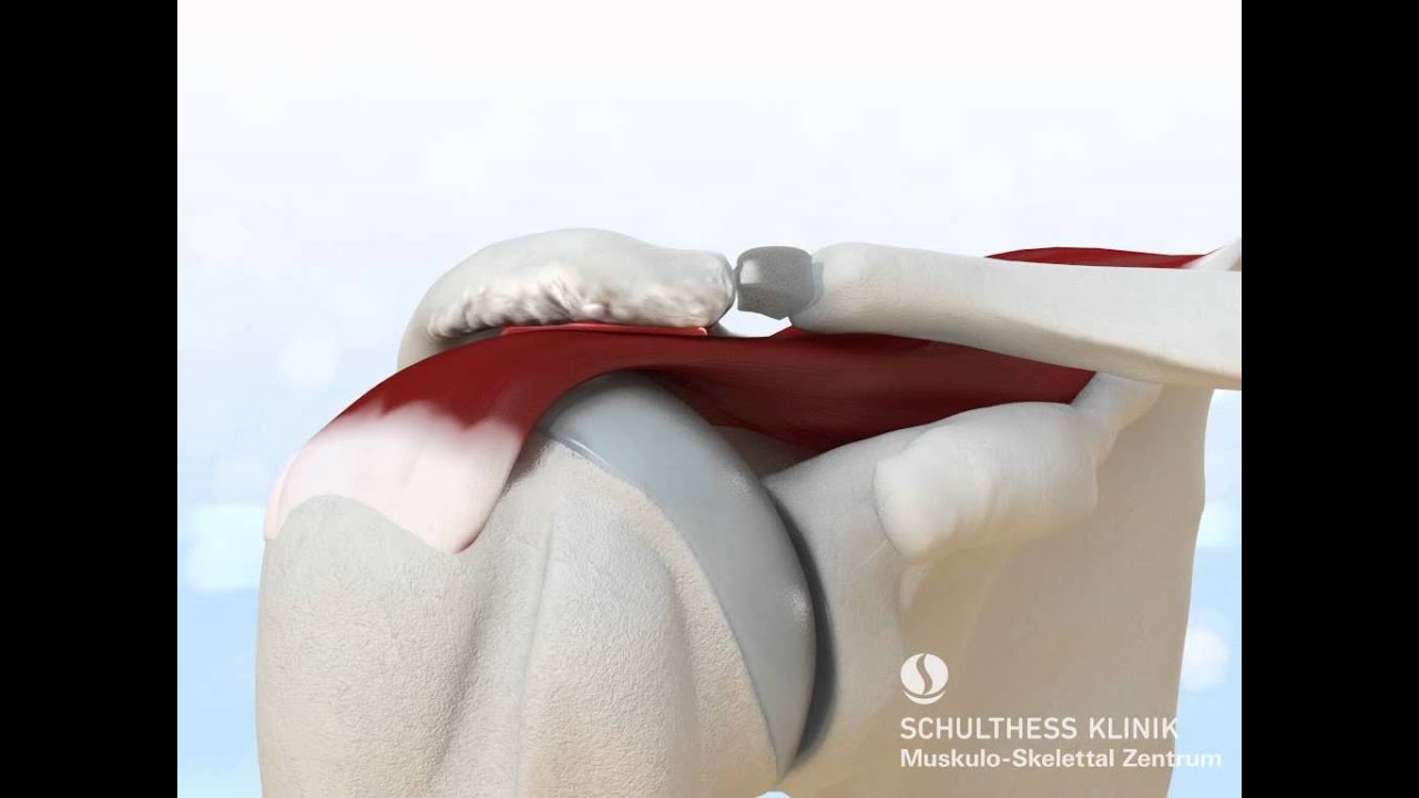 «Impingement Syndrom» - Schulthess Klinik