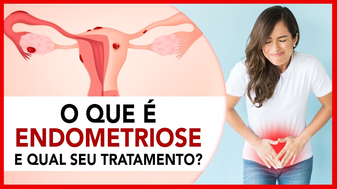 O que &eacute; Endometriose e qual seu tratamento?
