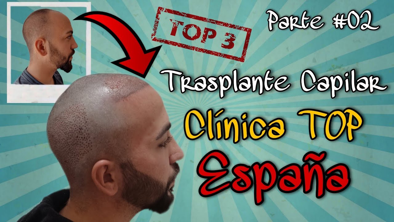 #03.- Trasplante capilar en CLÍNICA DE FREITAS, España. Parte 2 // Clínica TOP España
