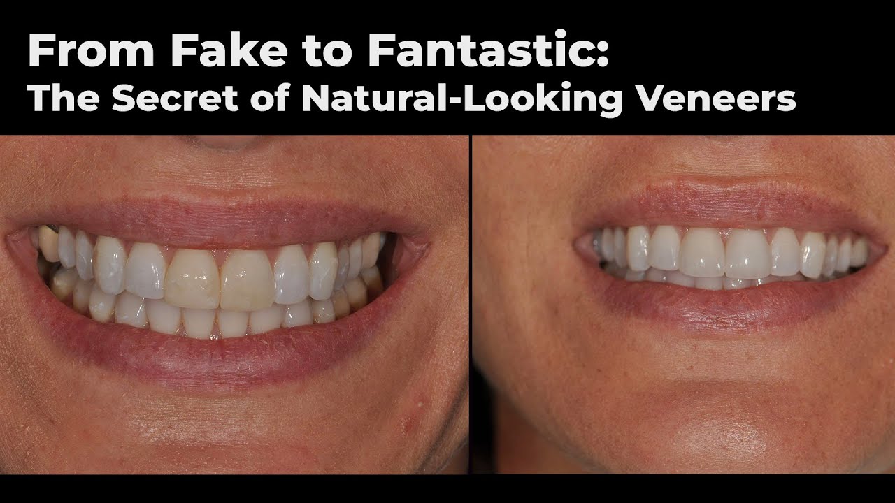 From Fake to Fantastic: The Secret of Natural-looking Veneers