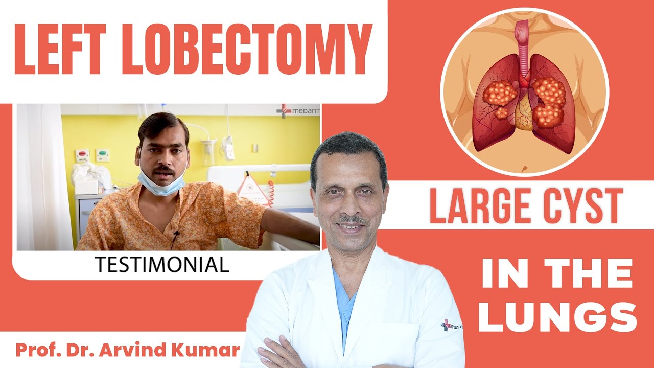Left Lobectomy | Large Cyst in the Lungs | Patient Testimonial | Prof. (Dr.) Arvind Kumar, Medanta