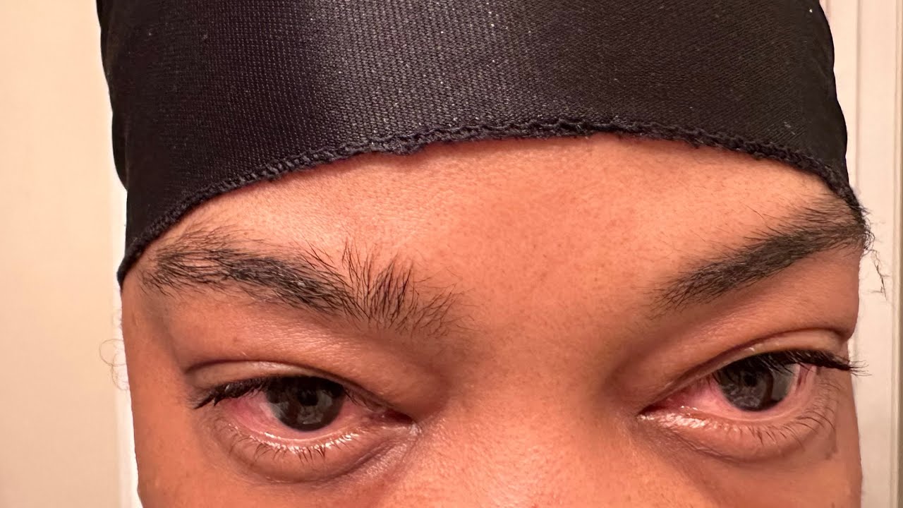 Vogt&ndash;Koyanagi&ndash;Harada (VKH) Finding out what is wrong with me Part 1 #vkh #autoimmunedisease