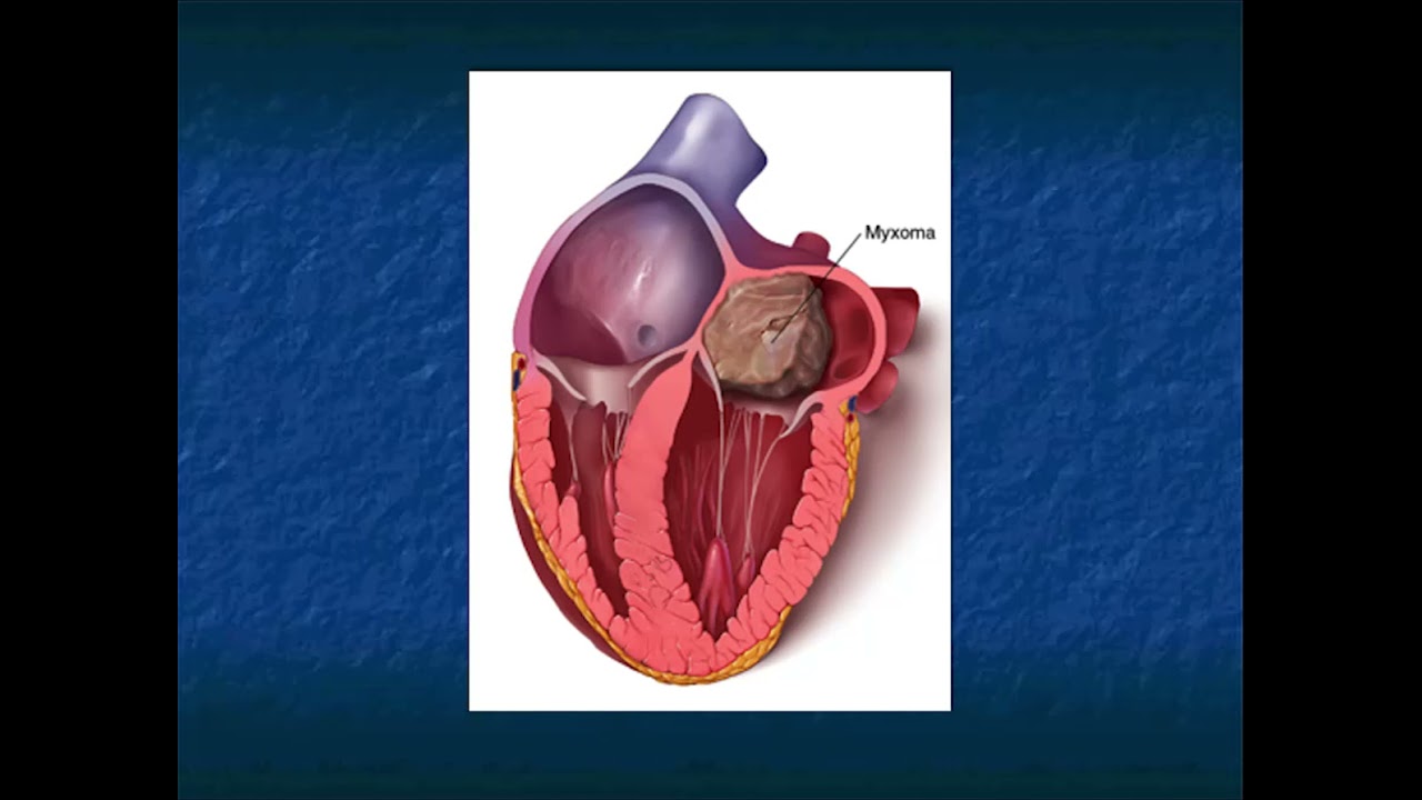 CT of Cardiac Masses: Pearls and Pitfalls - Part 1