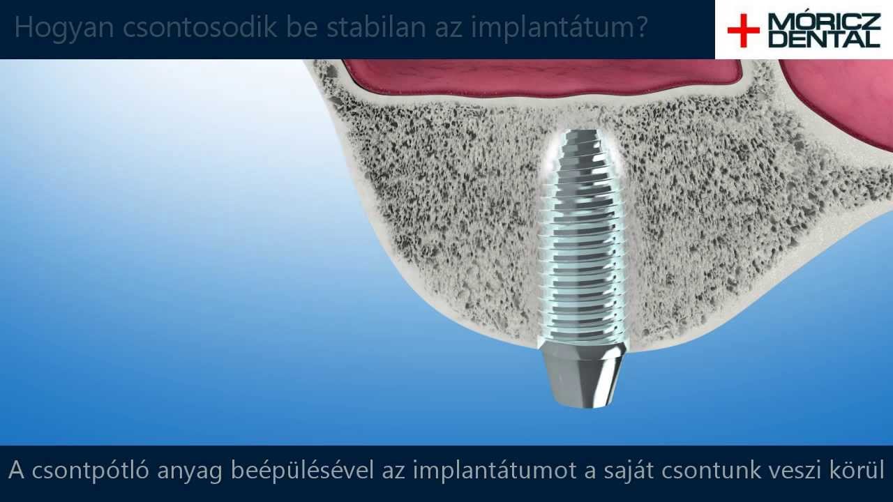 Csontpótlás a Móricz Dentalban - YouTube