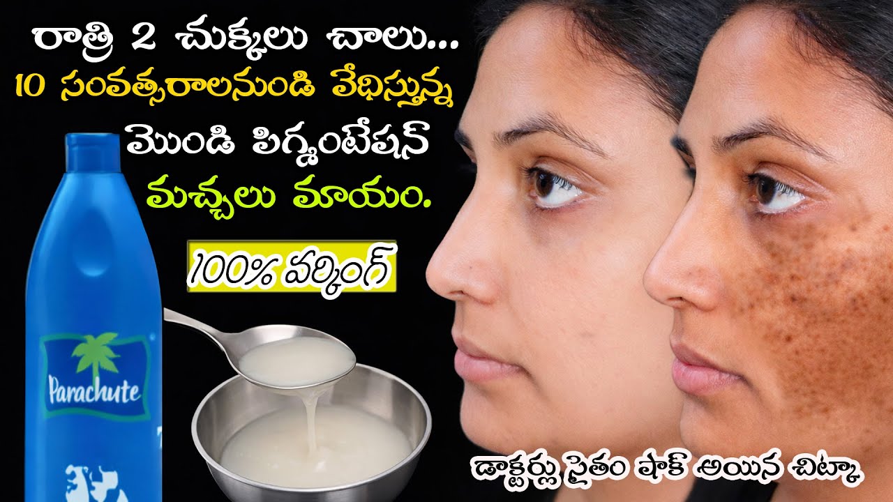 🔥ఇది రాత్రిపూట రాస్తే ఎంత మొండి పిగ్మెంటేషన్ అయినా, కేవలం 7 రోజుల్లో పోతుంది👌7 Days లో Clear Skin 💯