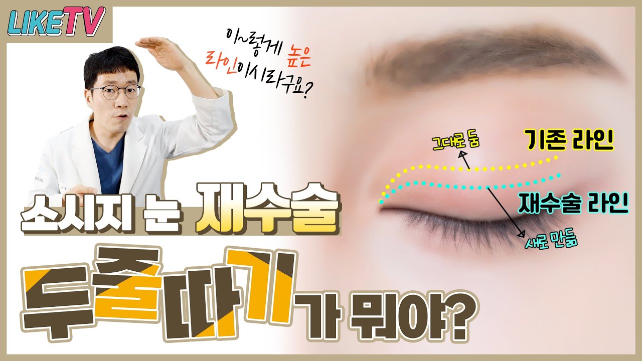 두줄따기가 뭐야?? 두줄따기의 모든 것!  l  #소시지쌍꺼풀 #라인낮추기 #눈재수술