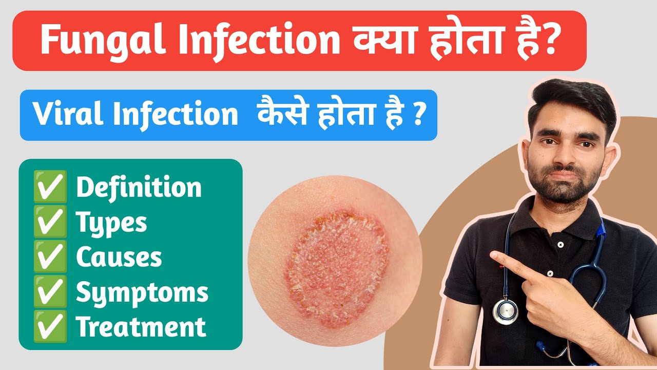 Fungal Infection Kya Kota Hai | Types, Causes, Symptoms And Treatment of Fungal Infection