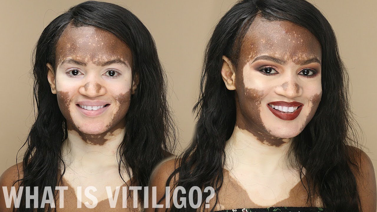 WHAT IS VITILIGO? A MAKEUP TUTORIAL! Don't COVER your vitiligo!