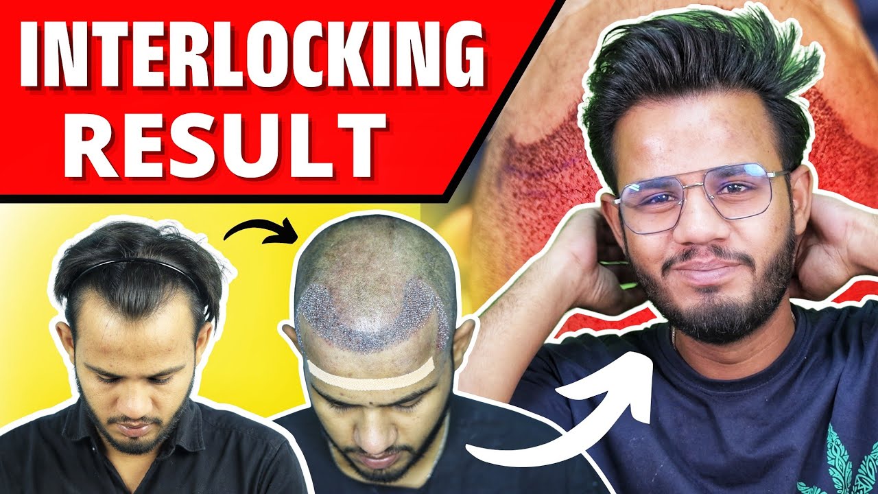 Interlocking Vs. Fue Hair Transplant Result 🔥 🔥🔥 Hair Transplant Cost In India 2025