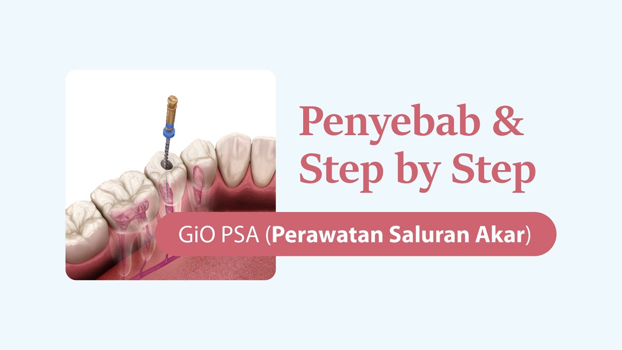 GiO Perawatan Saluran Akar (PSA) | Penyebab dan Step by Step