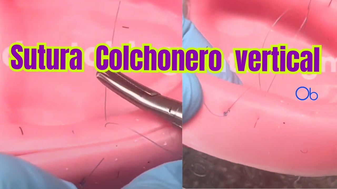 Sutura colchonero vertical