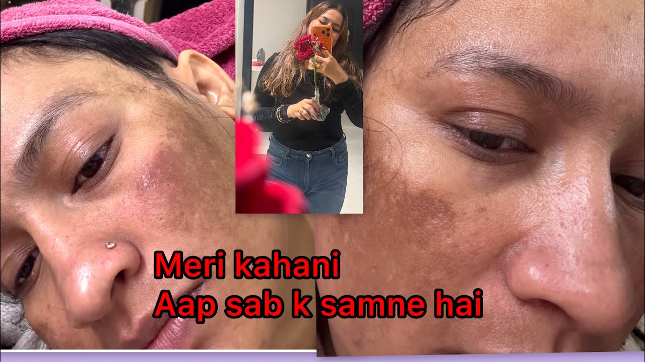 Cosmelan home kit ghar pe hi kare ! 