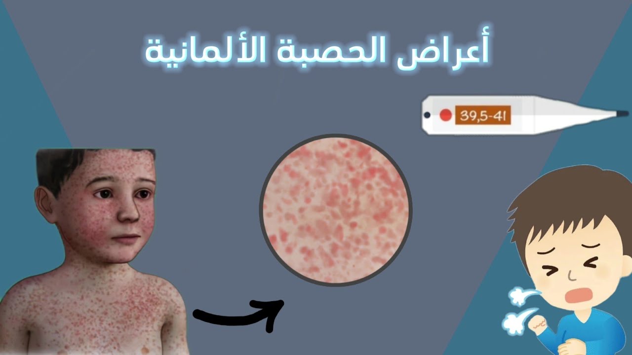 الحصبة الالمانية ، العلامات والاعراض الدالة على الاصابة بالحصبة الالمانية