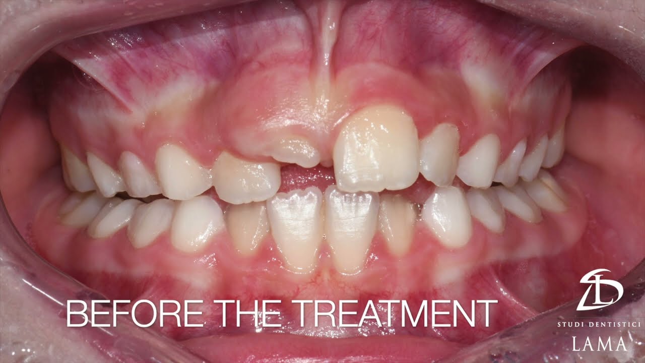 Orthodontic Treatment of Palatal expansion with rapid palate expander  - Time lapse