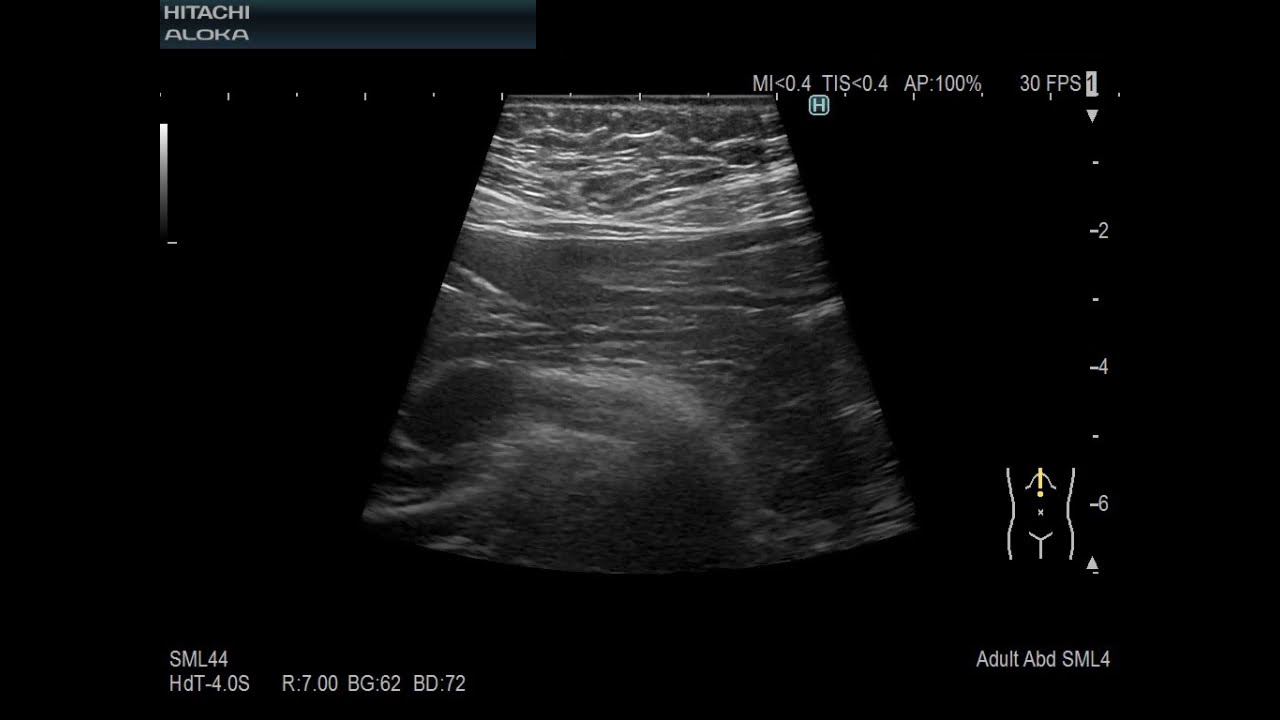 Dormed Hellas - ARIETTA 850 - Radiology CMUT Probe Whole Body