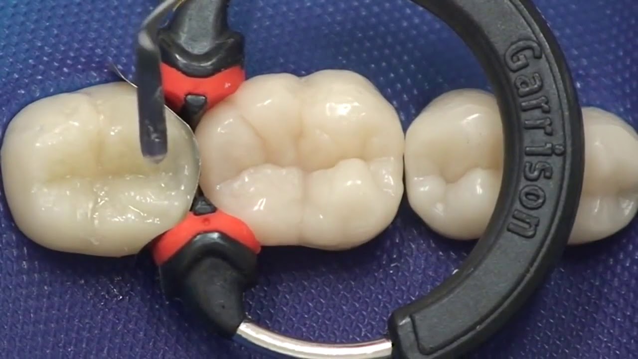 3M ESPE Filtek - Composite Restoration using Bulk Fill Technique PinkBlue.in
