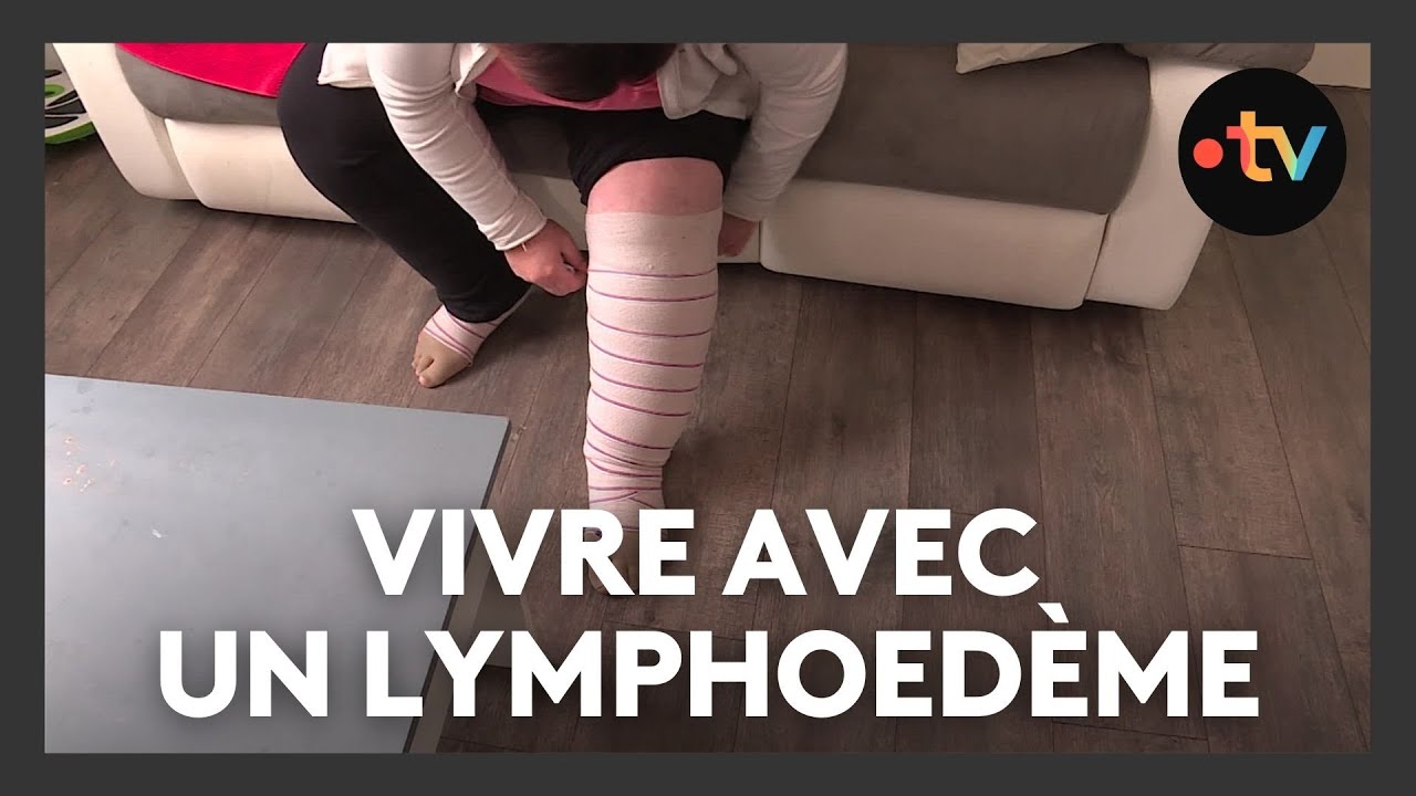 Vivre avec une maladie orpheline : le lymphœdème