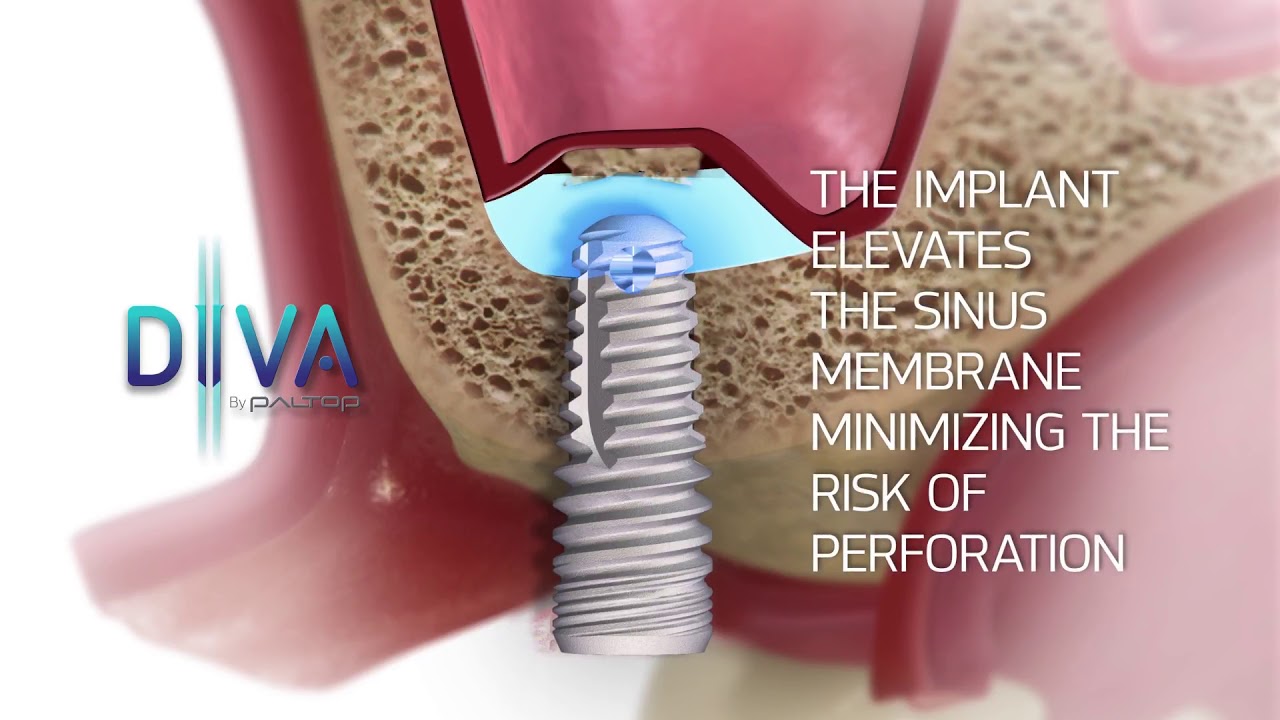 DIVA - Closed sinus lift and simultaneous bone regeneration