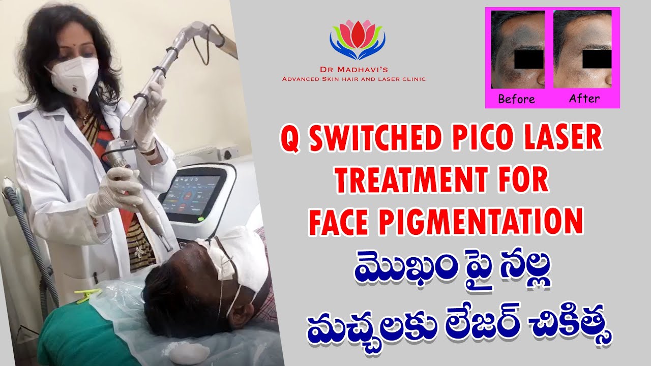 Q Switched Pico Laser treatment for Face Pigmentation
