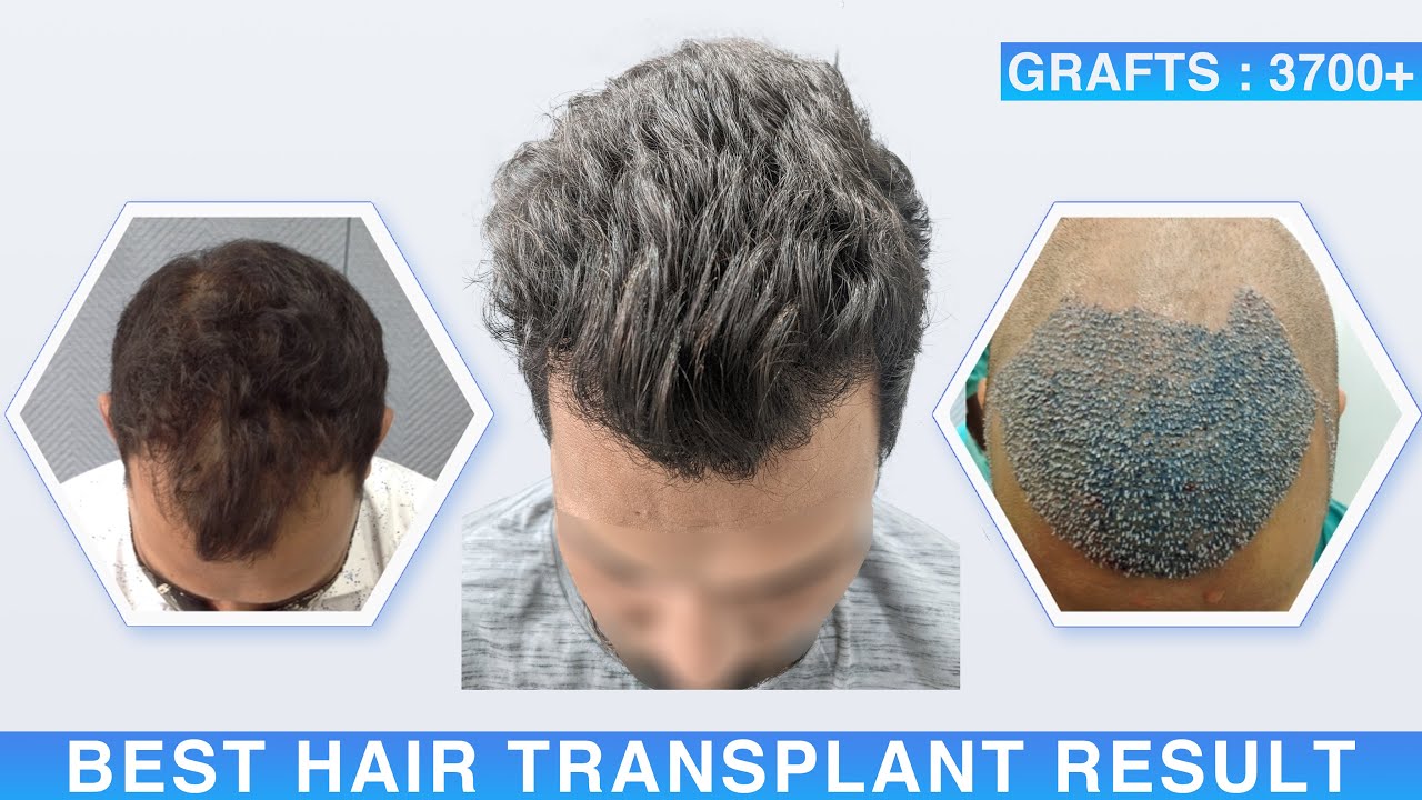 Hair Transplant Result HFHG Clinic in Ahmedabad || 3700+ Grafts, Grade-3 || By Dr. Richa Sanmukhani