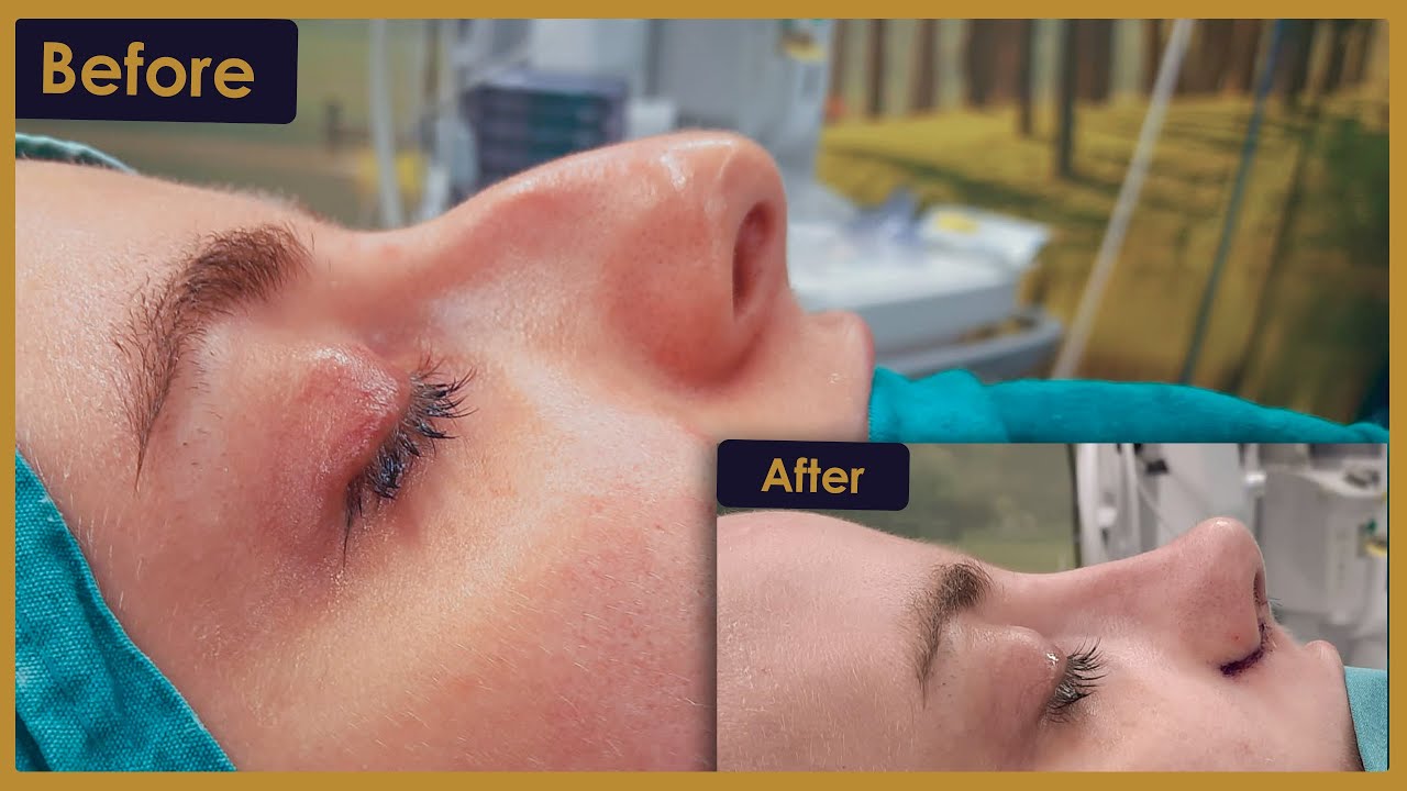 Lauren's Rhinoplasty Surgery Journey in Turkey! | Estherian Clinic