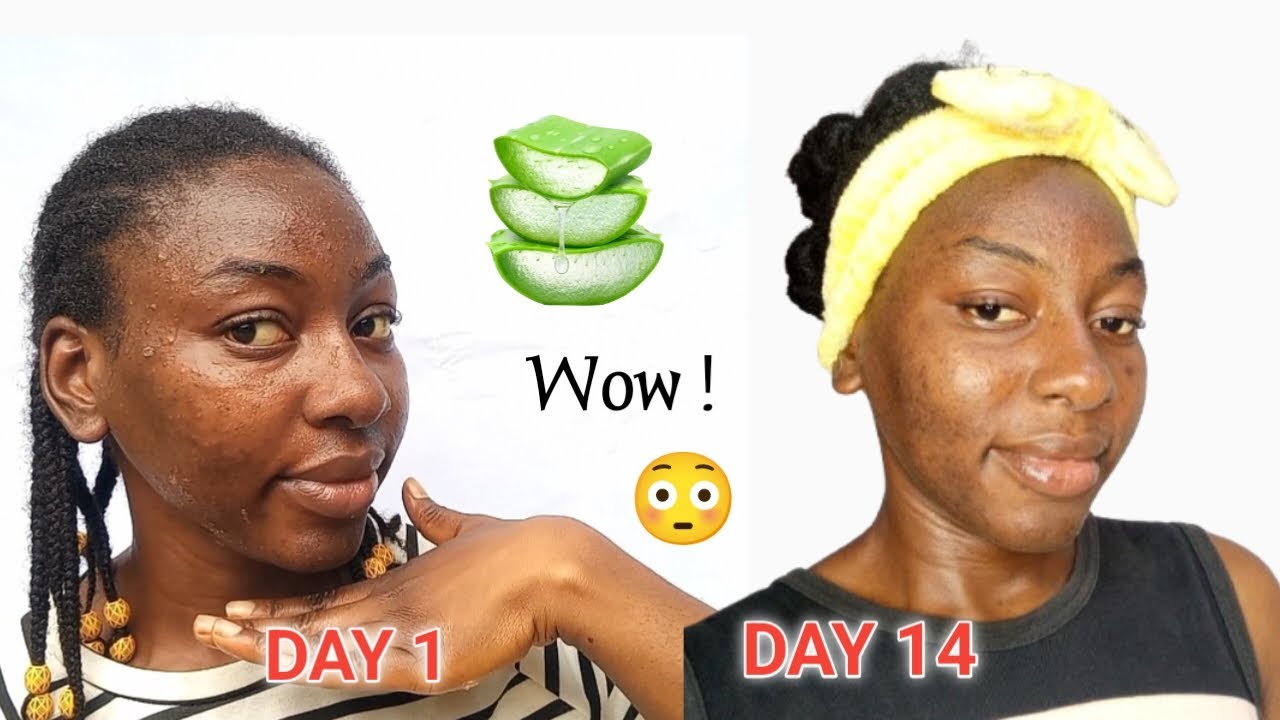 I USED FRESH ALOE VERA GEL EVERYDAY ON MY ACNE FACE FOR 2 WEEKS AND THIS HAPPENED 😳 Shocking Results