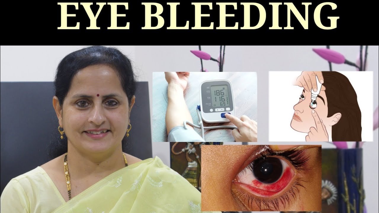 🩸Eye Bleeding🩸! Cause & Cure.