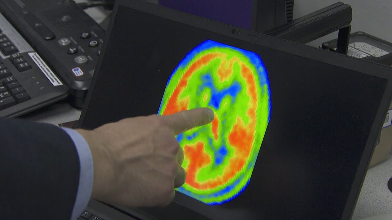 Brain inflammation found in some patients with long COVID